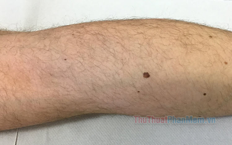 Nốt Ruồi ở Chân: Phân Tích Ý Nghĩa và Câu Chuyện