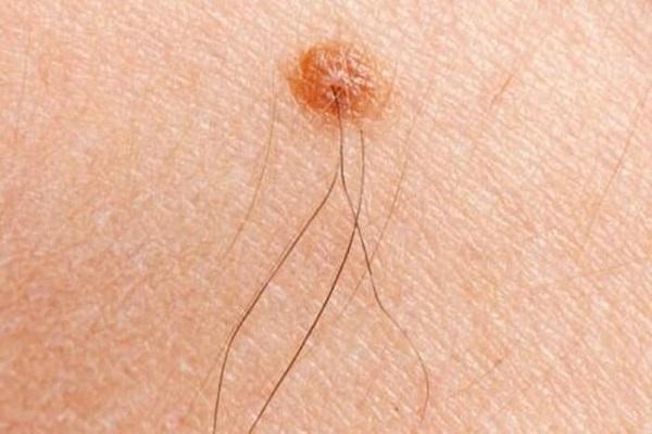 Nốt ruồi có lông có phải là dấu hiệu của bệnh ung thư không?