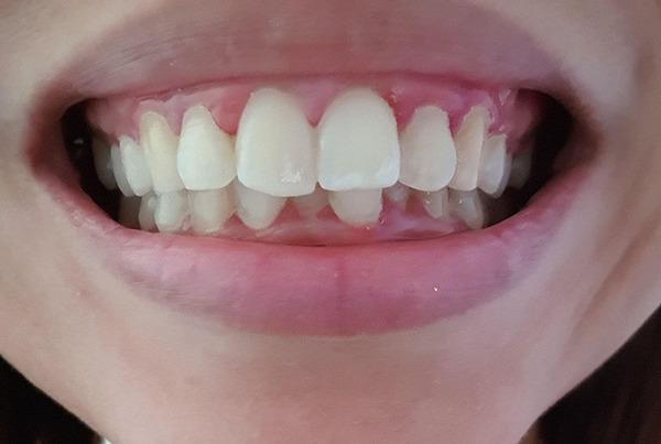 Răng cửa của một số người sẽ bị to và hô