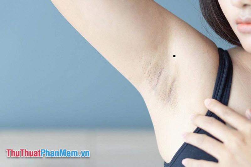 Nốt ruồi ở nách: Bí mật số mệnh và tính cách