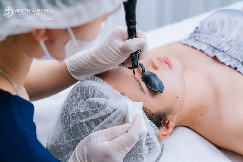 Xóa nốt ruồi ở quai hàm nên ưu tiên chọn địa chỉ uy tín