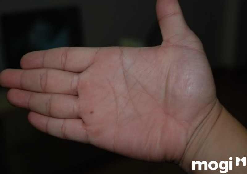 Gò Thái dương có nốt ruồi son